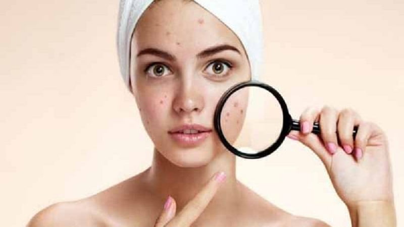 যে খাবারগুলো বিরক্তিকর ব্রণ প্রতিরোধে সহায়ক