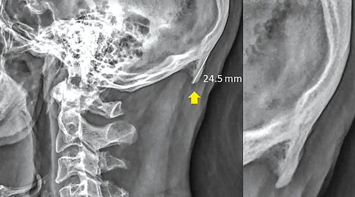 দীর্ঘক্ষণ স্মার্টফোন ব্যবহার করেন? আপনার মাথায় গজাতে পারে শিং!