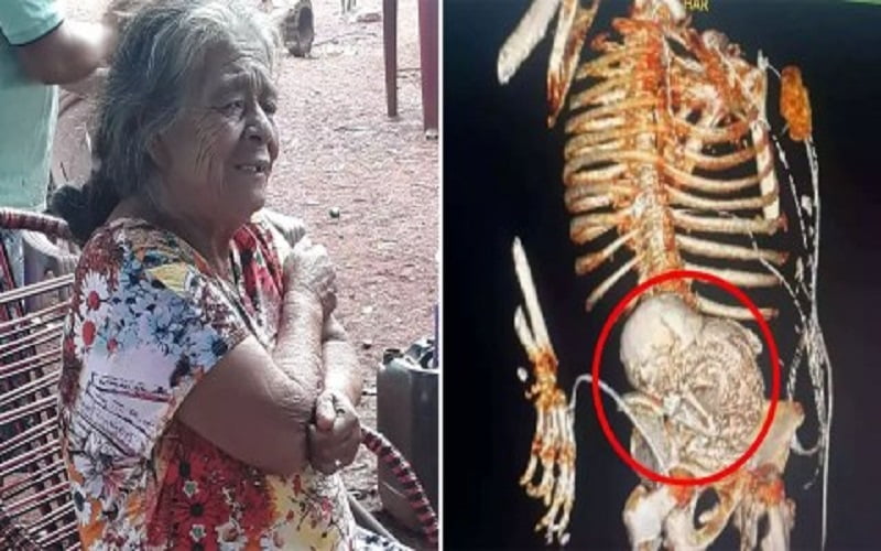 ৫৬ বছর ধরে গর্ভে সন্তান লালন! - West Bengal News 24