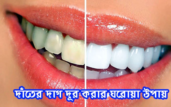 Home Remedies to Remove Tooth Stains : দাঁতের দাগ দূর করার ঘরোয়া উপায় - West Bengal News 24