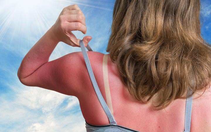 Sunburn : সানবার্ন নিয়ে সতর্ক থাকুন, সানবার্নের জ্বালা বাড়ায় স্কিন ক্যানসারের ঝুঁকি - West Bengal News 24
