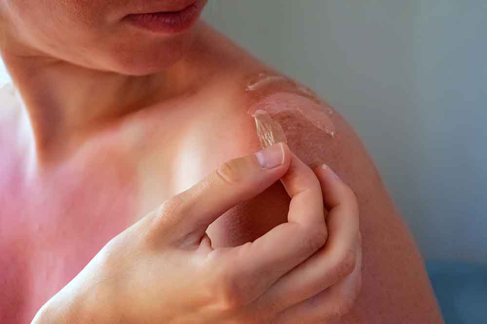 Sunburn : সানবার্ন নিয়ে সতর্ক থাকুন, সানবার্নের জ্বালা বাড়ায় স্কিন ক্যানসারের ঝুঁকি - West Bengal News 24