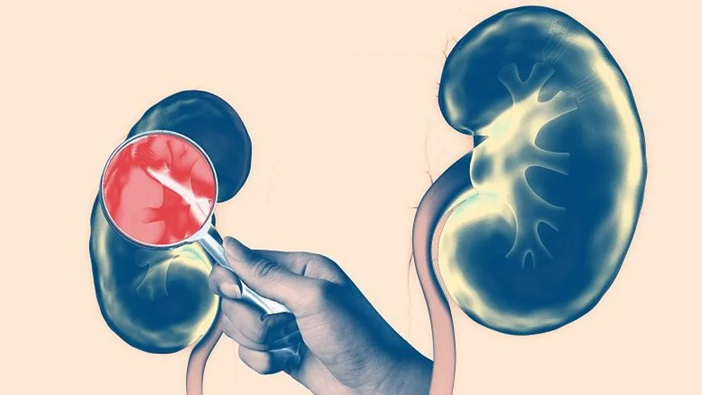 কিডনির রোগের আসল কারণ খুঁজে পেলেন গবেষকরা - West Bengal News 24